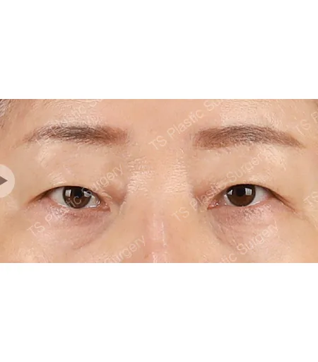 综合眼部整形术后
