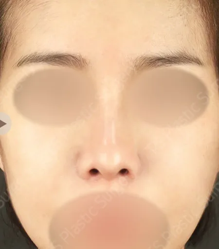 短鼻挛缩鼻修复术后