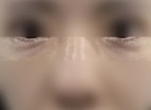 眼下填充术前案例一