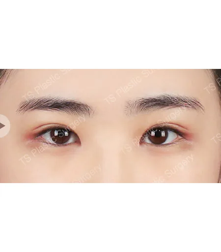 自然粘连双眼皮眼角术后