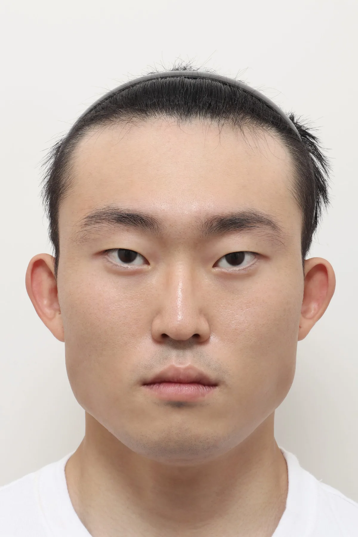 Note整形外科男性综合面部整形术前