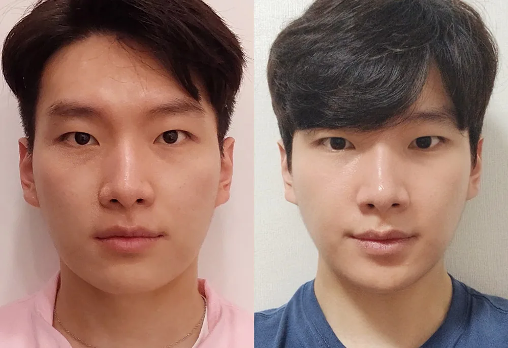 男士中下面部埋线提升术前术后