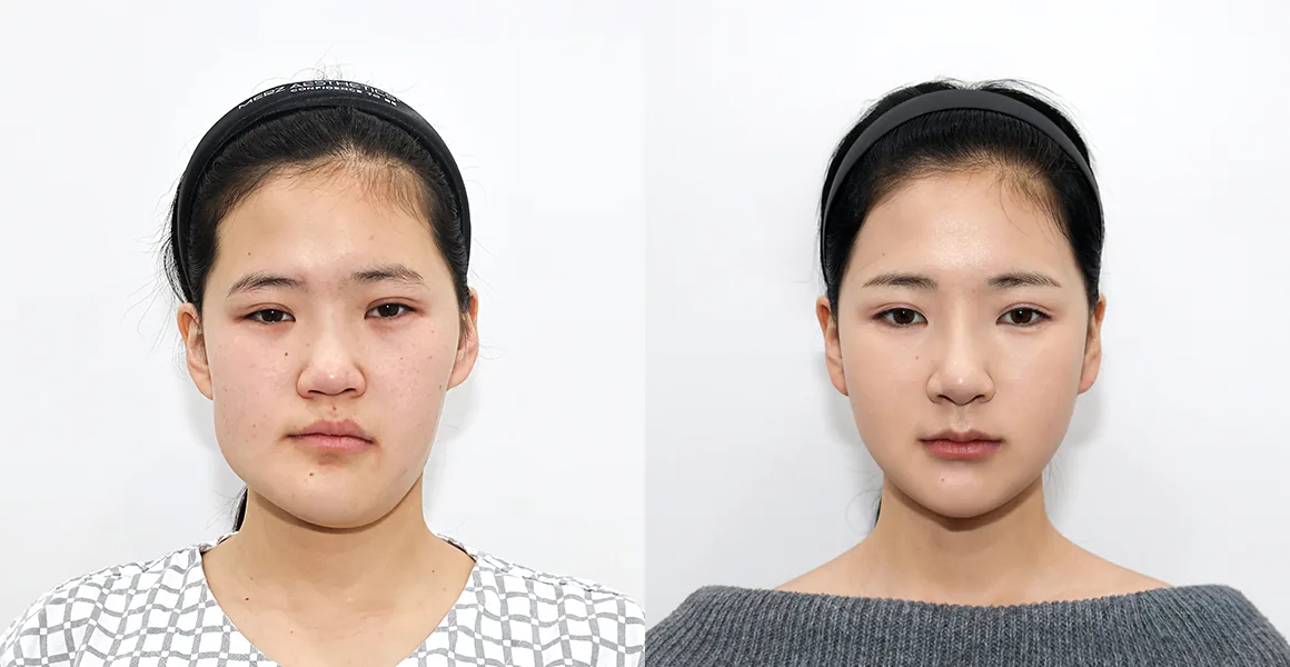 百分之一整形外科正颌轮廓和鹈鹕手术术前术后案例