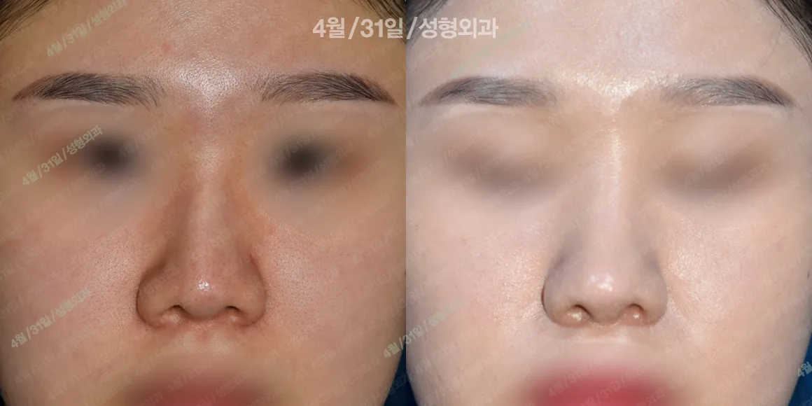 April 31美容外科 症例写真 4