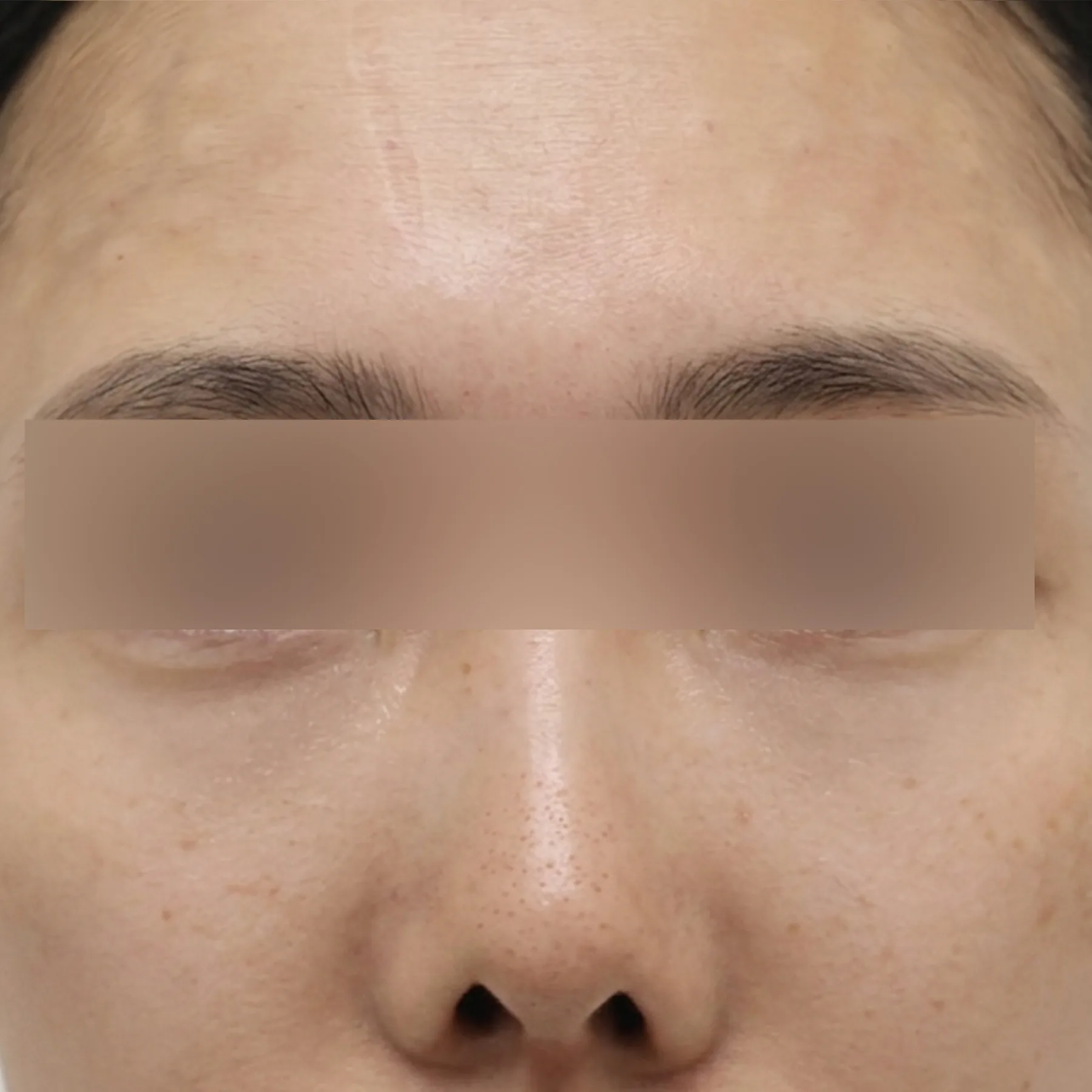 眼周综合方案术后案例一