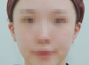 耳部填充术前