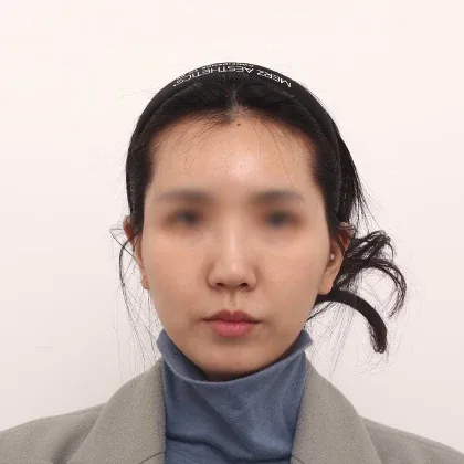 BOMON额头太阳穴填充术后