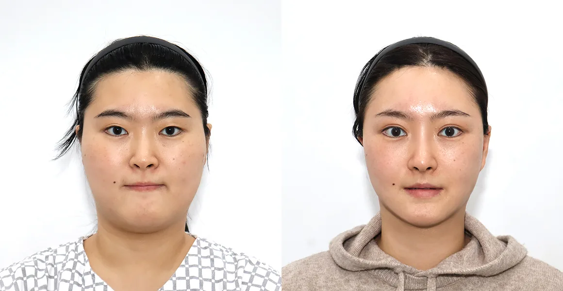 百分之一整形外科正颌轮廓和面部吸脂术前术后案例