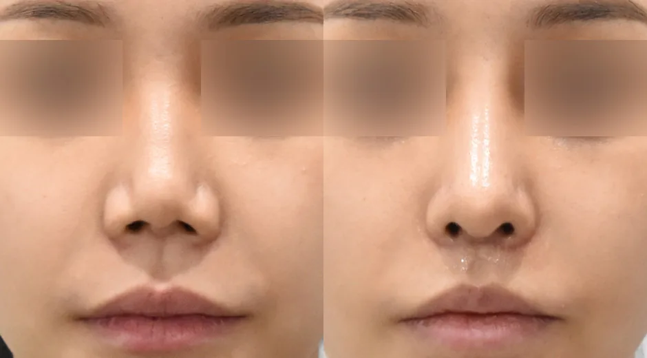 人中鼻修复与人中缩短术前术后对照