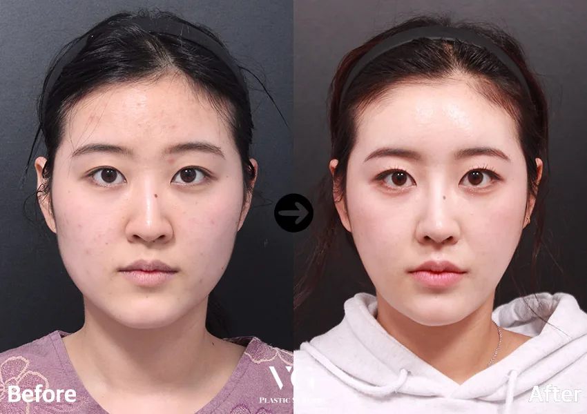 Very Good Plastic Surgery Before-and-after cases 20