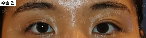 爱护整形外科埋线双眼皮眼型矫正及开内眼角术前