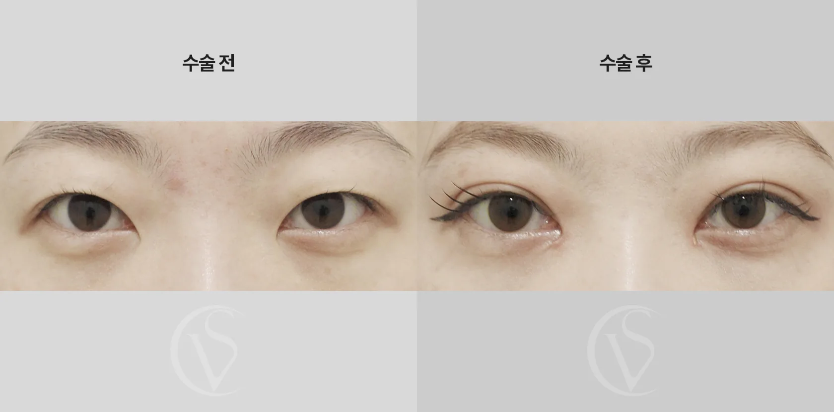 공식 전후 사례 8