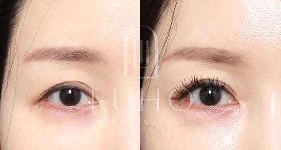 Luho眼部修复术后3个月案例