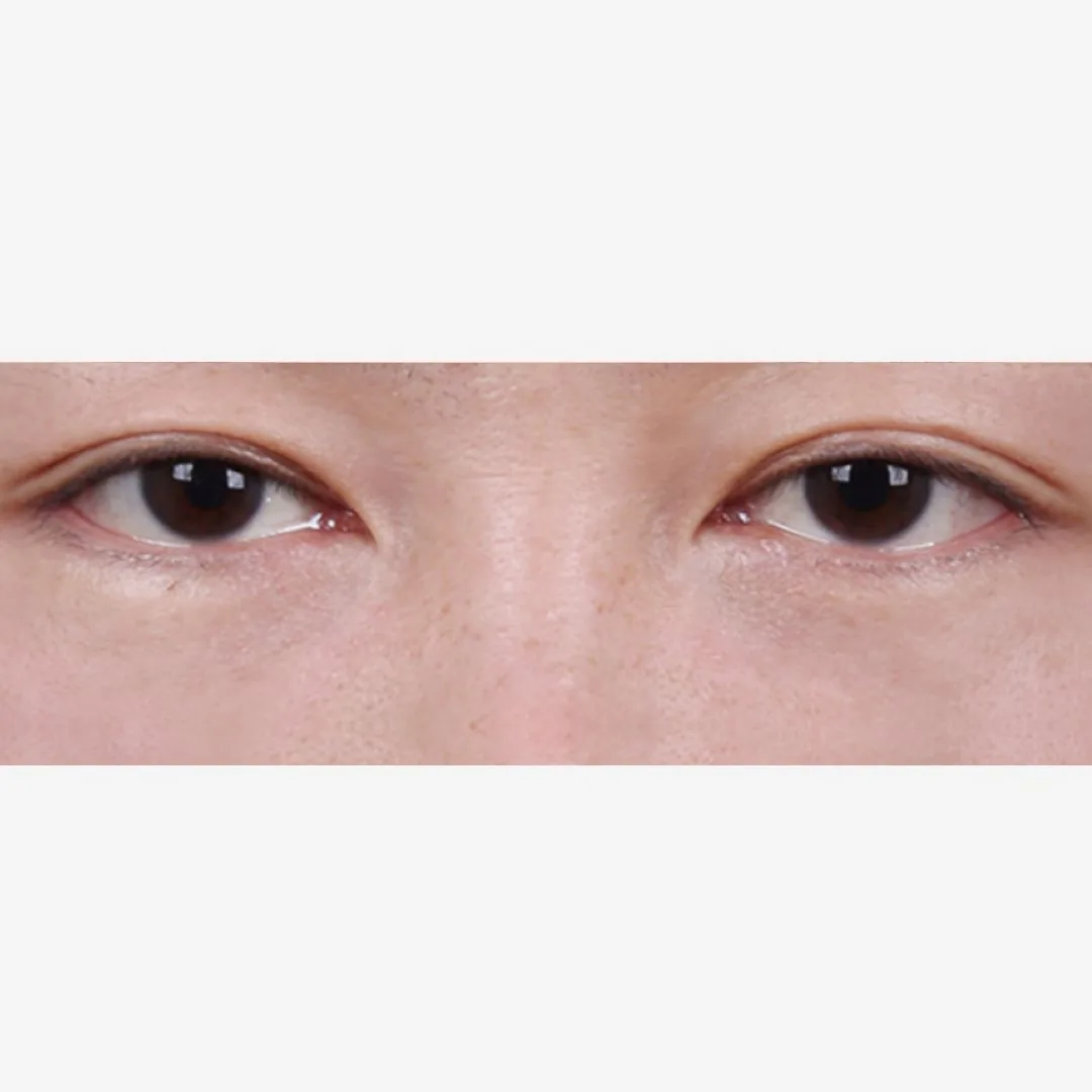 官方術前術後案例 6