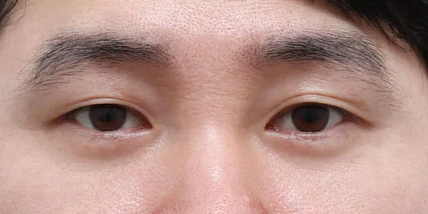 Must眼下脂肪重排术后1个月案例二