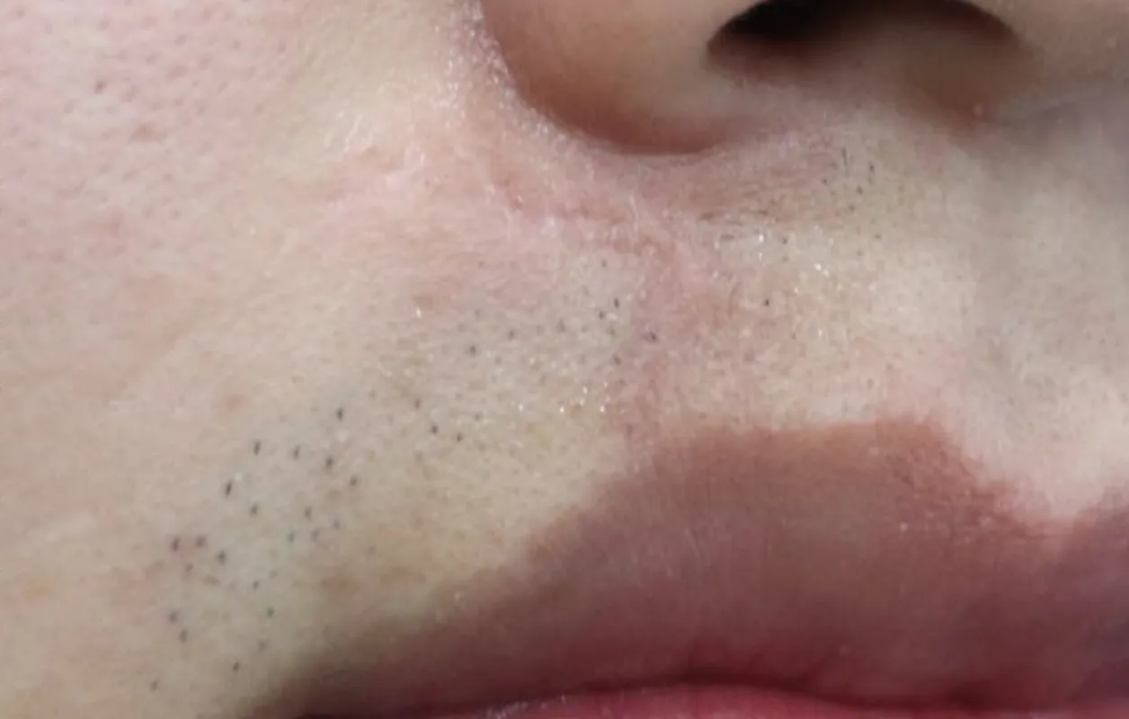 人中瘢痕切除术后