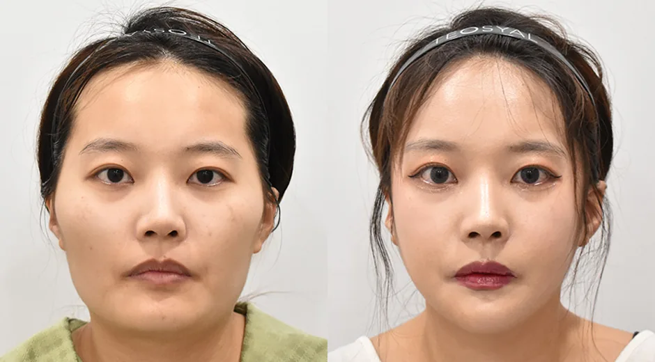 下巴截骨颧骨缩小与下颌角整形术前术后对照