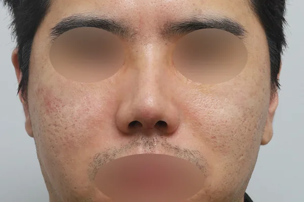 鼻部整形案例7术后7天