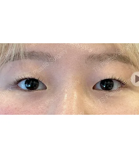 切开双眼皮术前