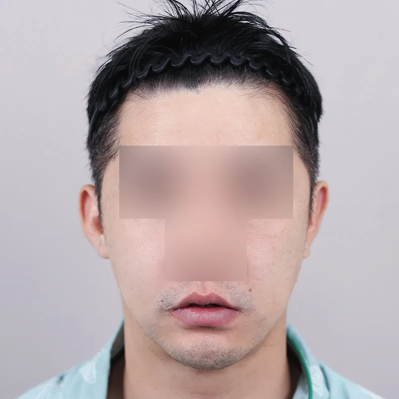 官方術前術後案例 10