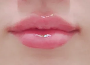 唇部填充术后案例一