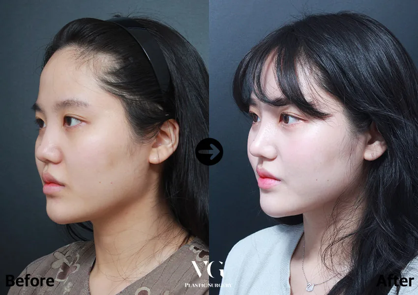 Very Good Plastic Surgery Before-and-after cases 9
