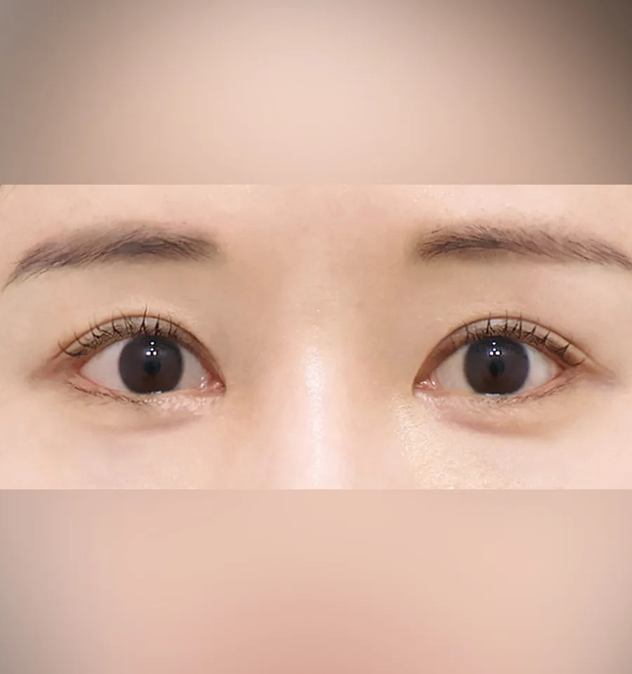 普爱德眼部修复术后5个月局部照片