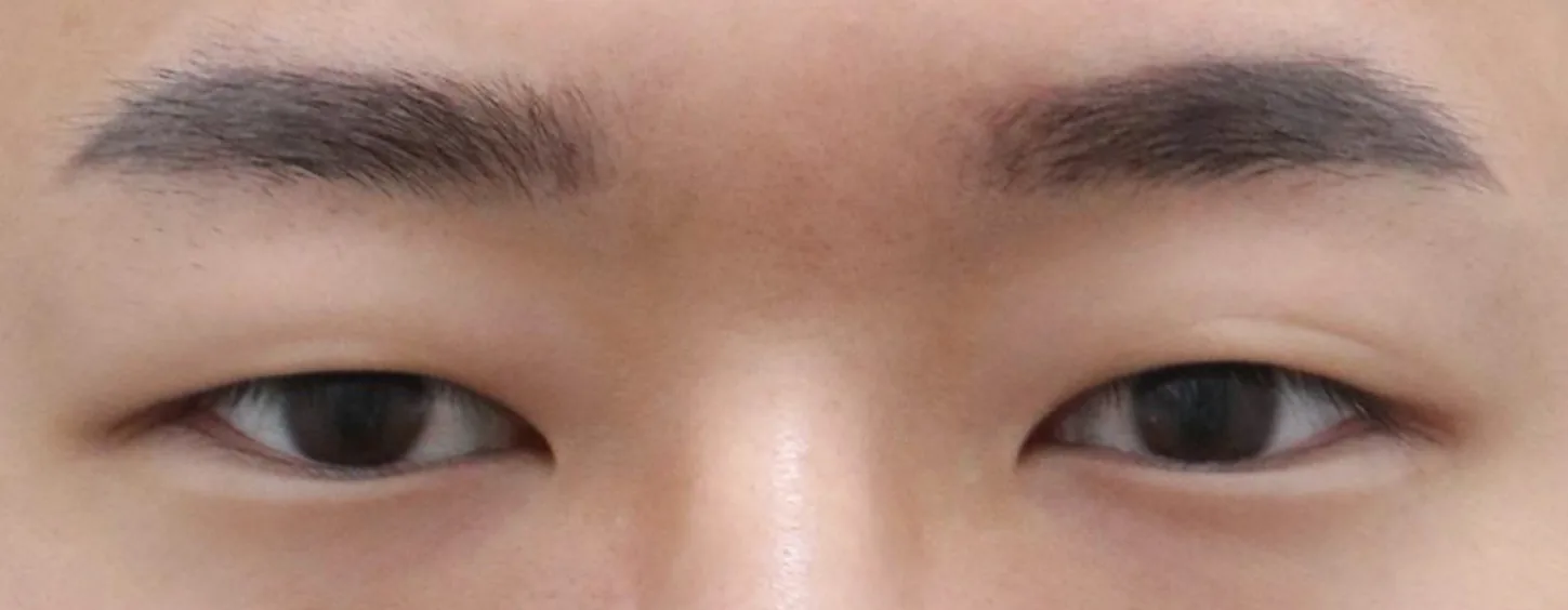 Note整形外科自然粘连脂肪去除术前