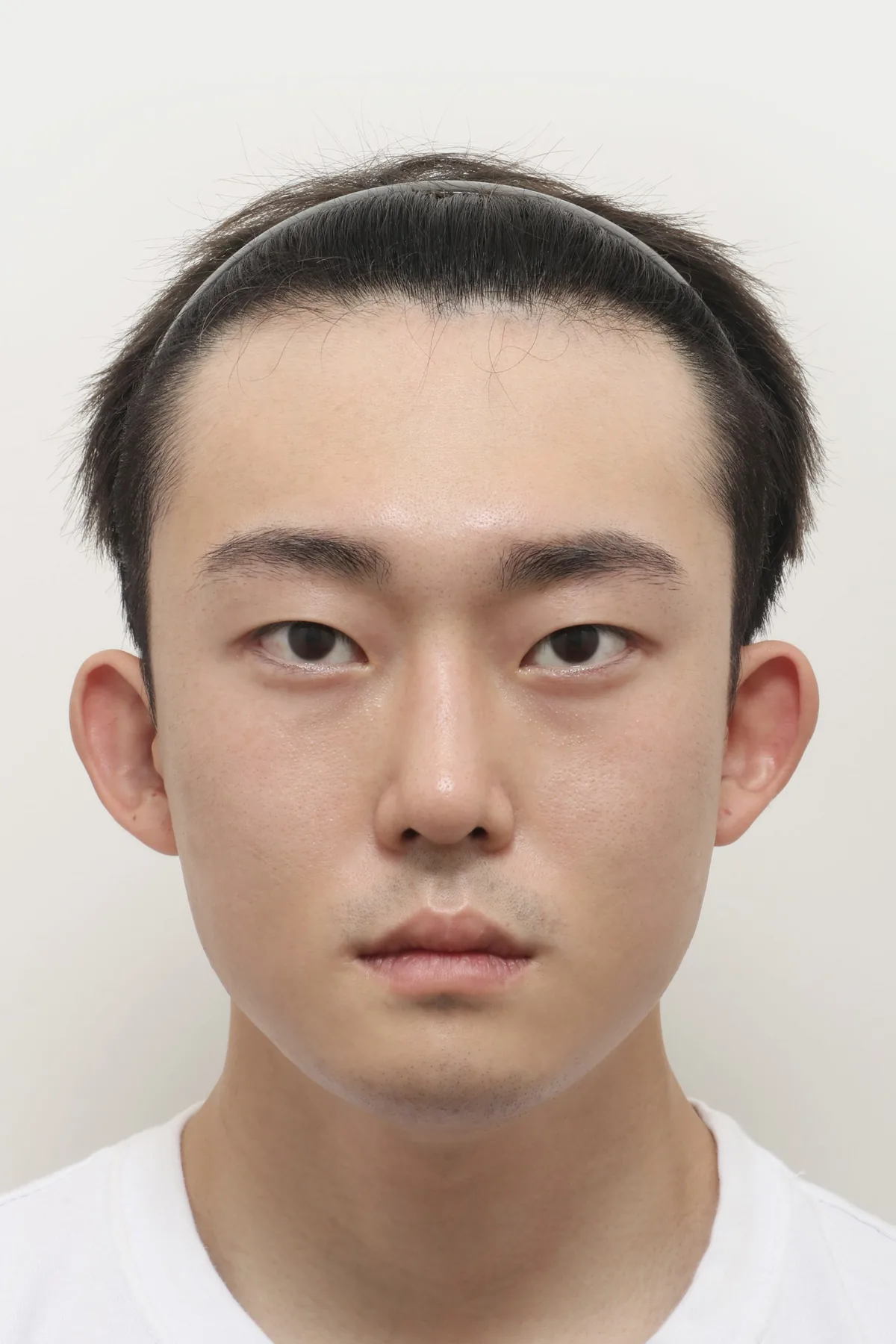 Note整形外科男性综合面部整形术后1个月