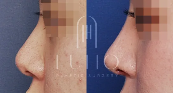 Luho鼻梁鼻尖整形术后1个月案例三