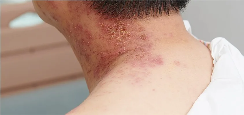 vanh颈部皮肤治疗记录术前