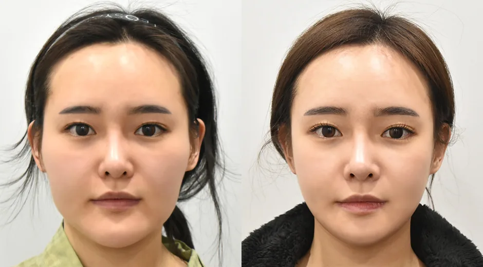 下巴缩小颧骨缩小与下颌角整形术前术后对照