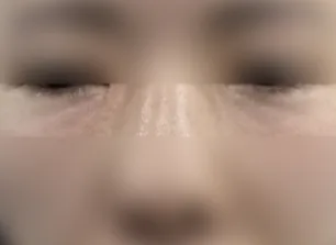 眼下填充术后案例一