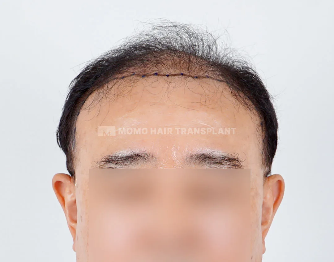 毛茂切开式毛发移植3500毛术前正面