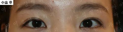 爱护整形外科埋线双眼皮及开内眼角术后1个月