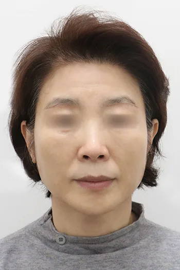 Note整形外科上下睑眉提升术后6个月