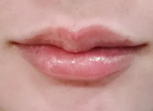 唇部填充术后案例二