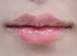 唇部填充术后案例五