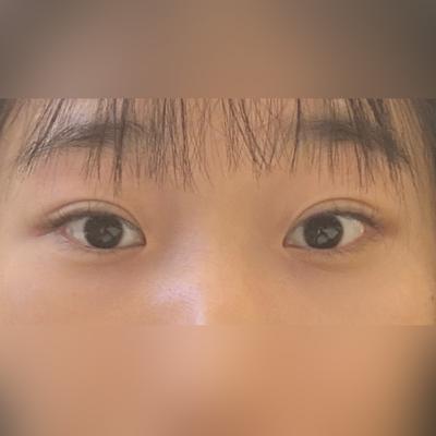 術後4週