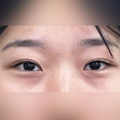 術前
