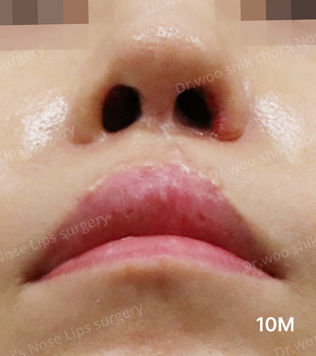 術後10個月|Noselips院方案例