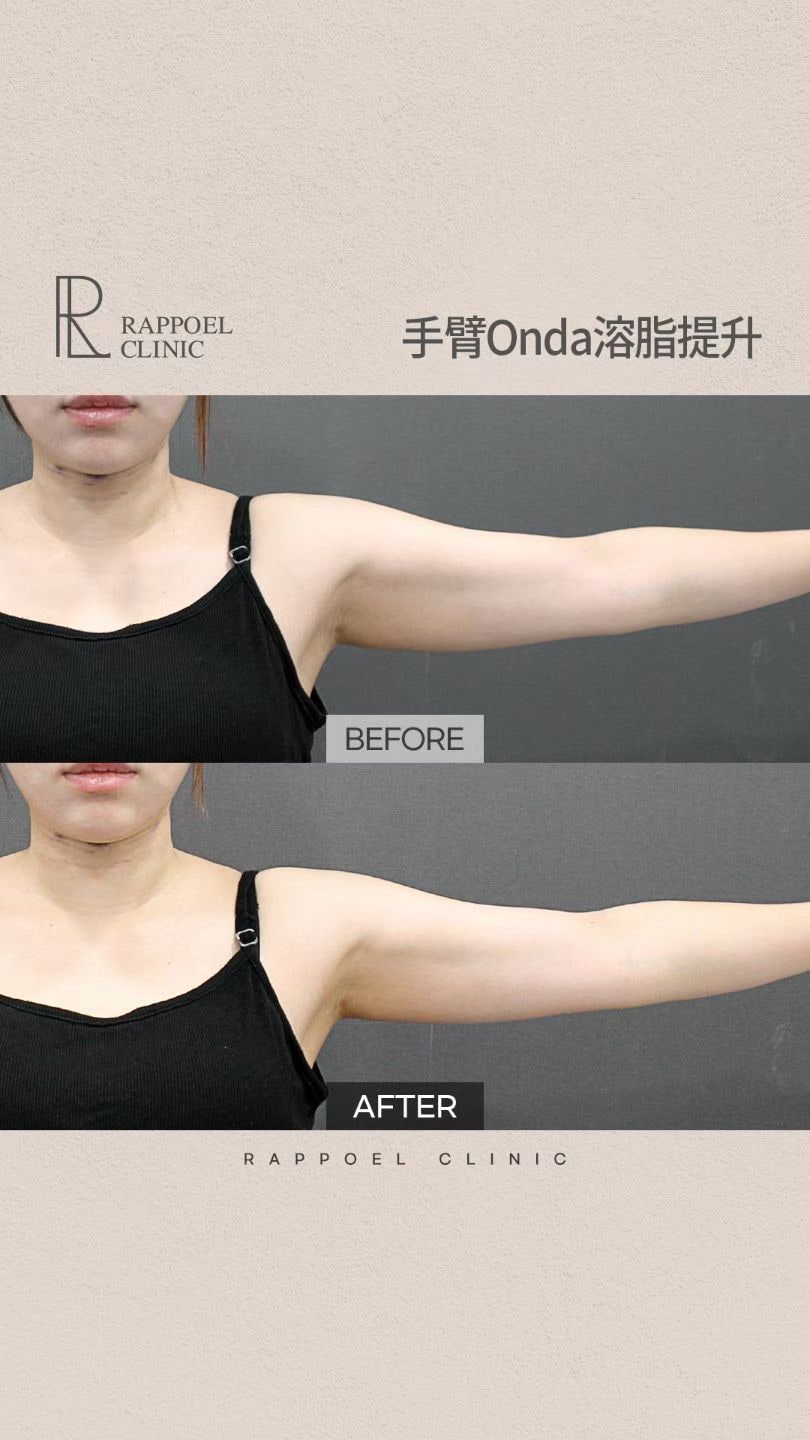 ONDA手臂施术前后院方公开案例二