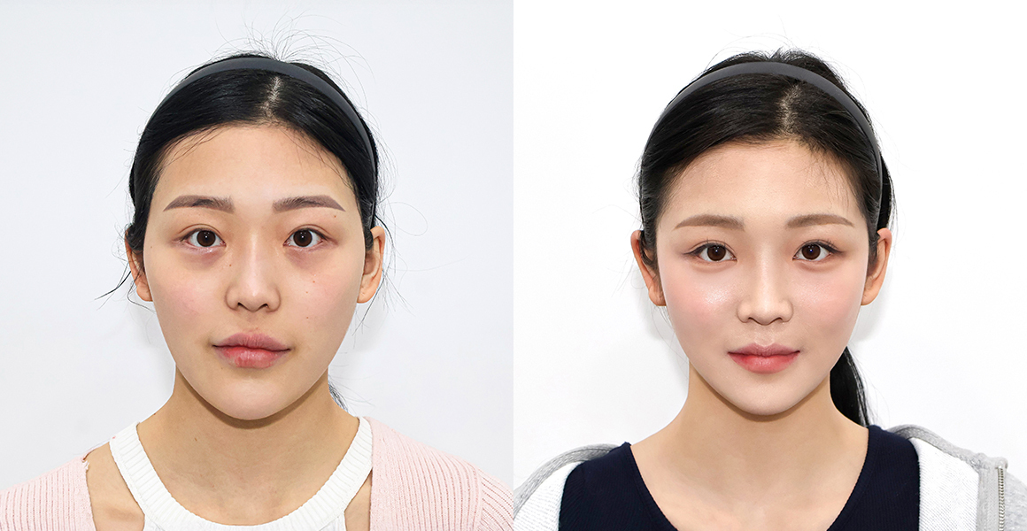 
1%美容外科 矯正プラスカスタマイズされた ミニVライン の 10 か月前後の比較
