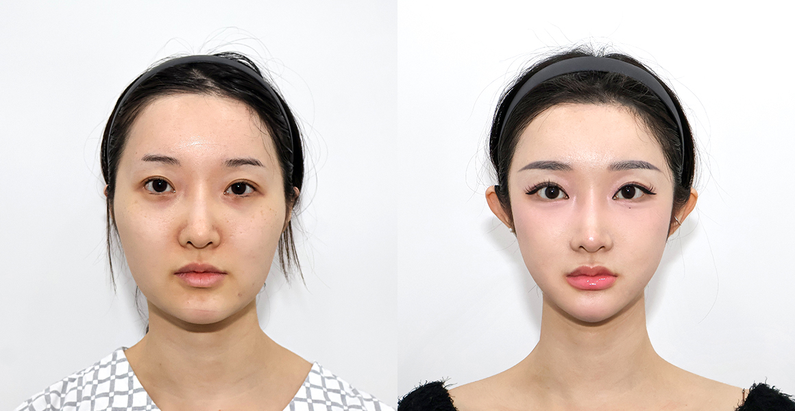 
術後7ヶ月の1%美容外科とオーダーメイドVラインの上下顎頬骨の比較
