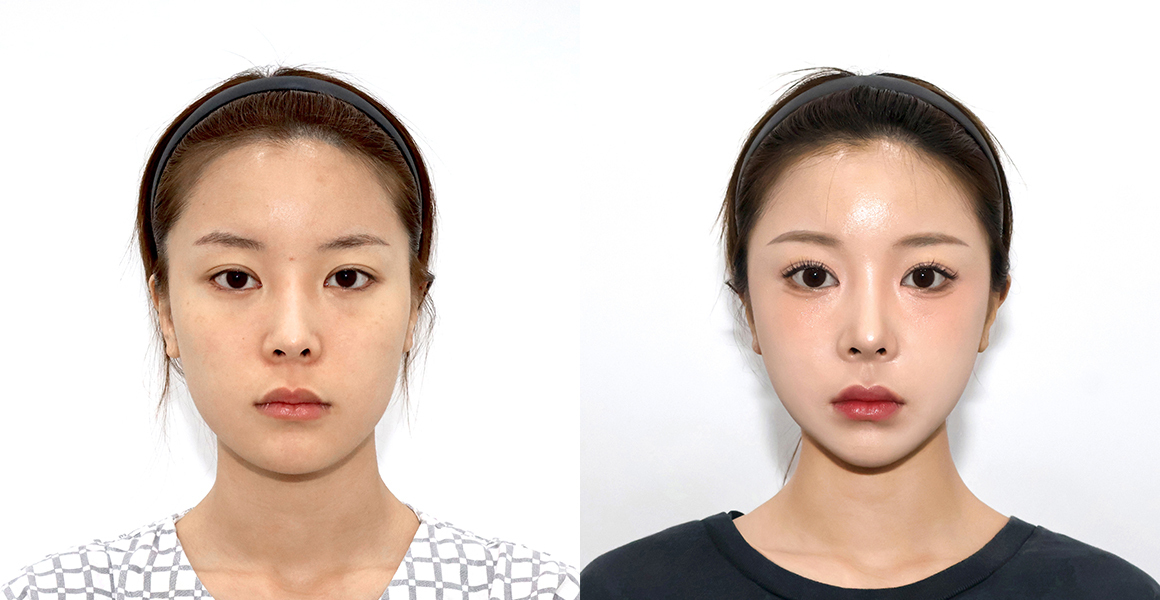 
1%美容外科High-3D頬骨縮小術オーダーメイドVライン、アキュリフトの術後1年の公式症例