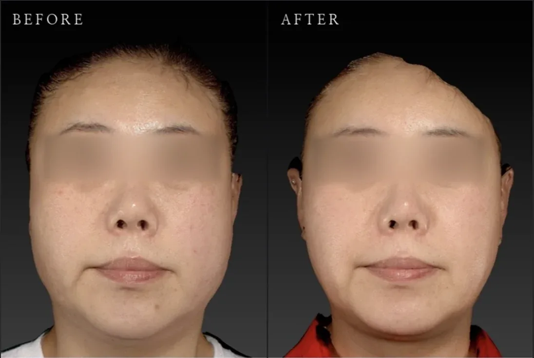 Ca trước–sau chính thức 18
