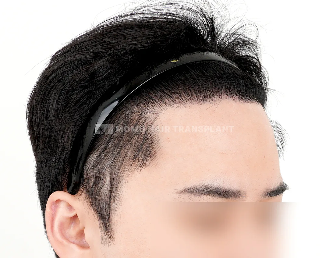 Ca trước–sau chính thức 2