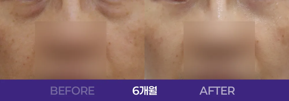 공식 전후 사례 1