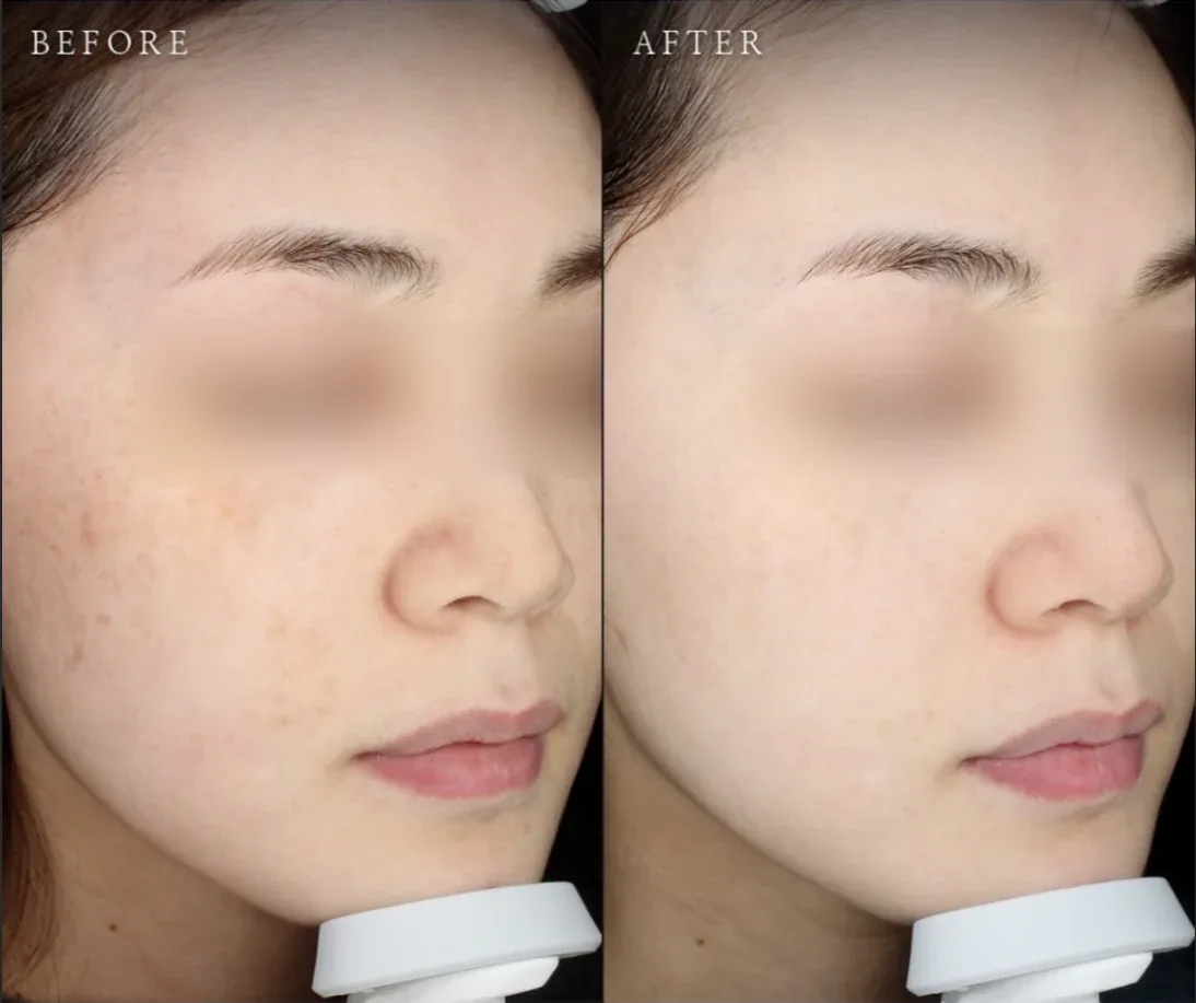 Ca trước–sau chính thức 8