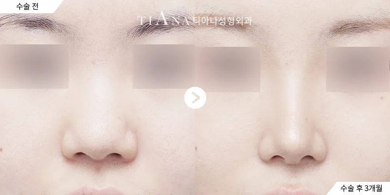 鼻修复与鼻形矫正 · 正面 · 左术前／右术后1个月